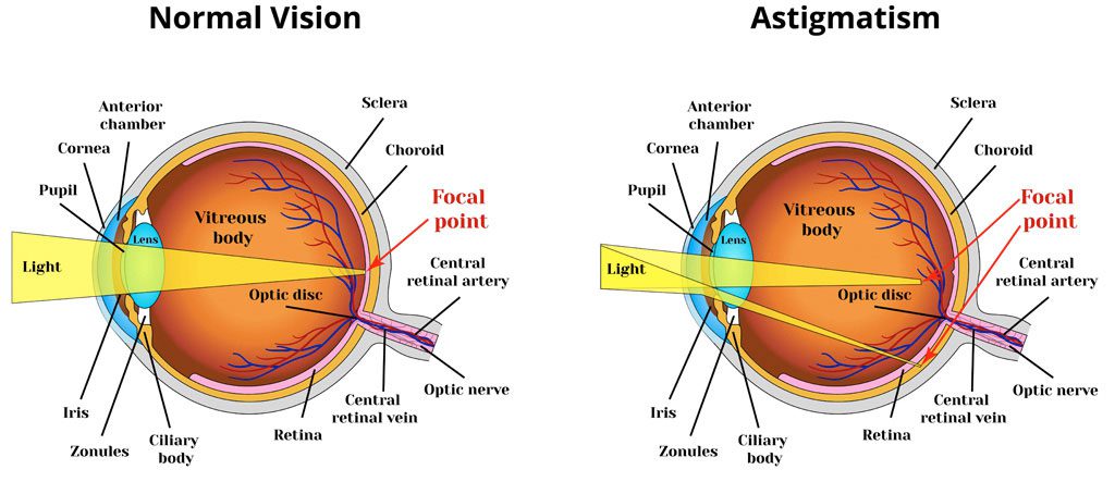 What Is Astigmatism What Does It Look Like LasikPlus