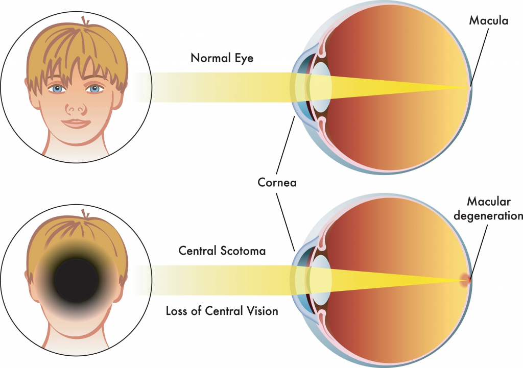 what is scotoma