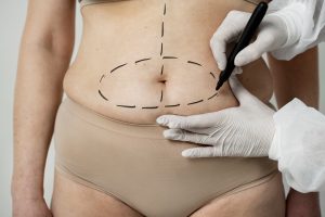 LASIK has better satisfaction rate than liposuction