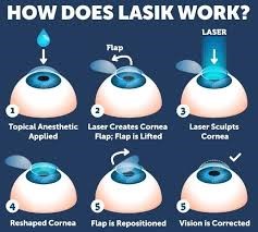 bladeless LASIK